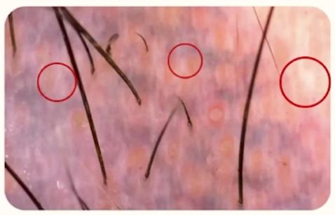 Caso de tricoscopia para identificar